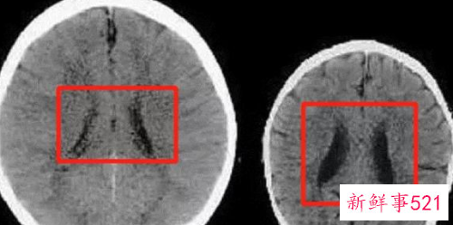 经常挨打的孩子会智力下降吗