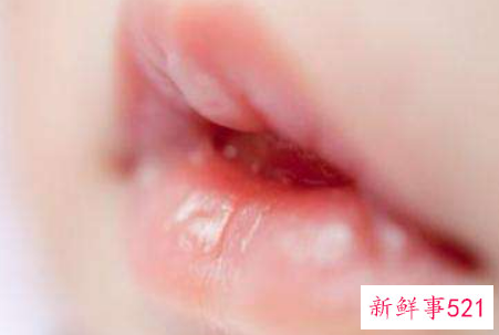 宝宝溃疡该怎么办