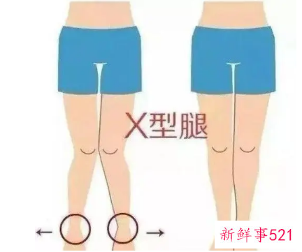 X腿型怎样才能变直