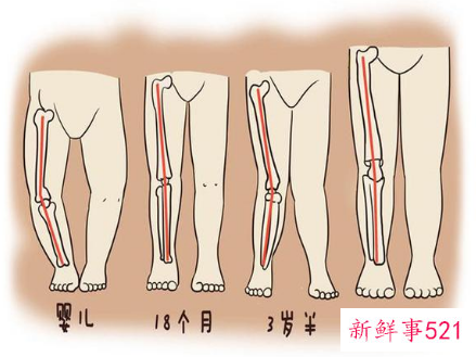 X腿型怎样才能变直