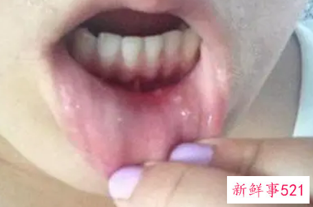 宝宝溃疡该怎么办