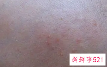 未满月婴儿脸上长很多小红粒怎么办