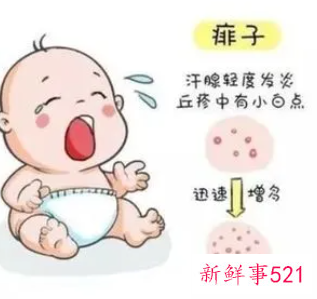 婴儿长痱子怎么快速消除止痒
