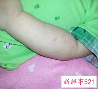婴儿长痱子怎么快速消除止痒