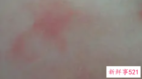 新生儿皮肤红斑色变怎么办