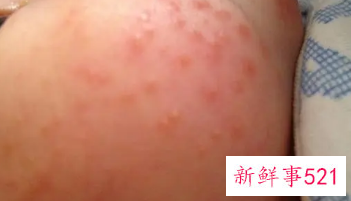未满月婴儿脸上长很多小红粒怎么办
