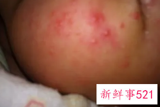 未满月婴儿脸上长很多小红粒怎么办