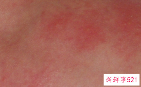 新生儿皮肤红斑色变怎么办