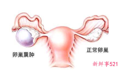 卵巢囊肿最佳治疗方案