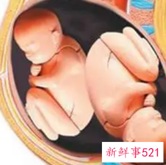 怀孕七个月胎位不正的原因