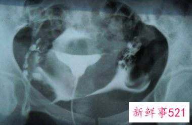 输卵管造影前能同房吗