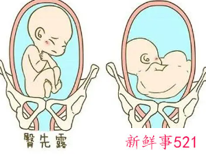 臀位的孕妇该怎么办