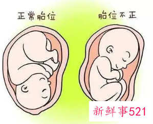 臀位宝宝危险吗