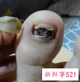 梦见脚趾甲掉了