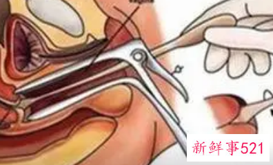 取白带和内检哪个更疼