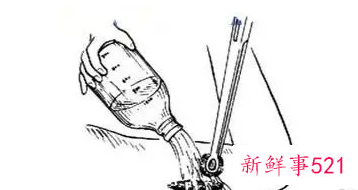 包茎手术后多久消肿