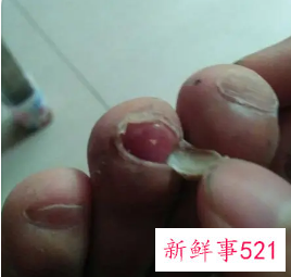 梦见脚趾甲掉了