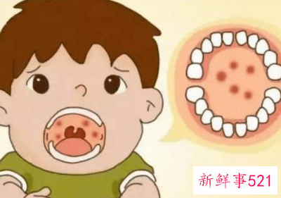 疱疹性咽峡炎的症状