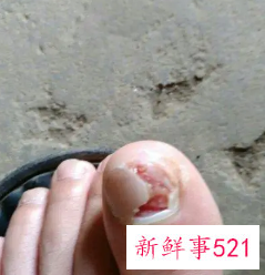 梦见脚趾甲掉了