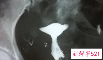 输卵管造影前能同房吗