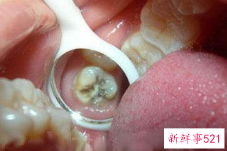 哪些坏习惯容易导致宝宝蛀牙