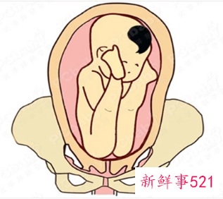 臀位宝宝危险吗