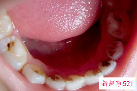 哪些坏习惯容易导致宝宝蛀牙