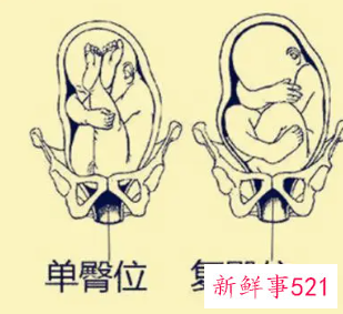 臀位的孕妇该怎么办