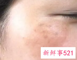 脸颊两侧长斑怎么调理祛除