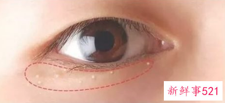 脂肪粒怎么去掉