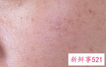 皮秒祛斑会伤害皮肤吗效果怎么样