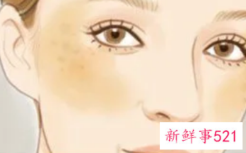 脸颊两侧长斑怎么调理祛除