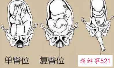 前置胎盘臀位孕妇少坐