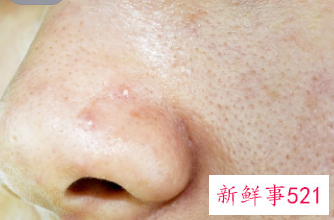 皮秒祛斑会伤害皮肤吗效果怎么样