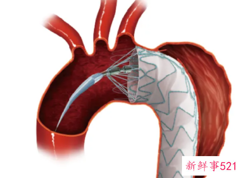 主动脉夹层是怎么样的