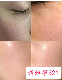 皮秒祛斑会伤害皮肤吗效果怎么样