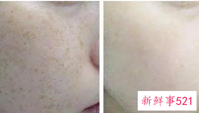 激光祛斑4次了越来越严重