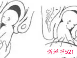 前置胎盘臀位孕妇少坐