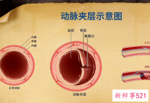 主动脉夹层是怎么样的