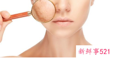 激光祛斑4次了越来越严重