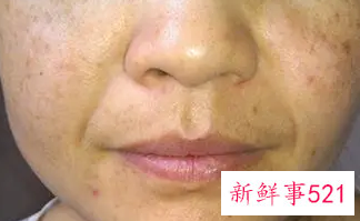 脸颊两侧长斑怎么调理祛除