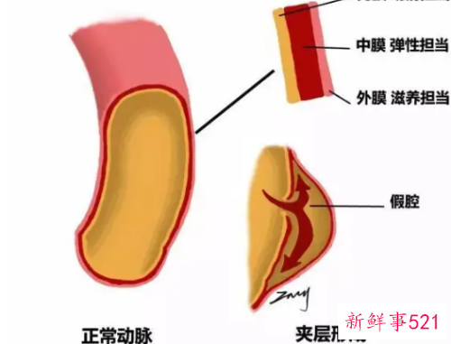 主动脉夹层是怎么样的