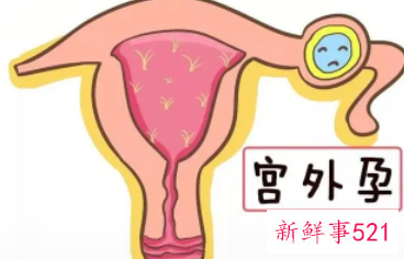 宫外孕的意思是什么
