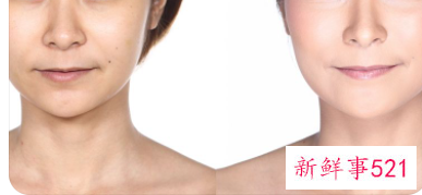 眼部填充脂肪多久恢复好