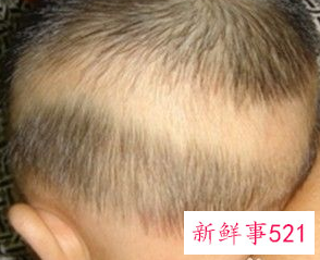 宝宝五个月枕秃怎么补钙