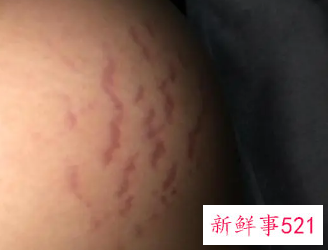 肚子孕辰纹能去掉吗