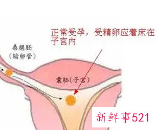 宫外孕的意思是什么