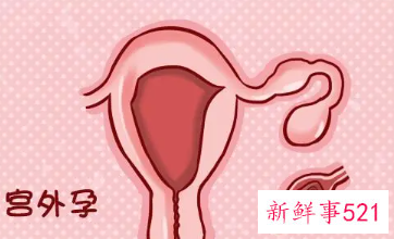 宫外孕的意思是什么