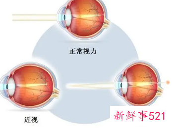 怎么让视力慢慢恢复