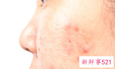 鼻梁两侧有粉刺怎么办